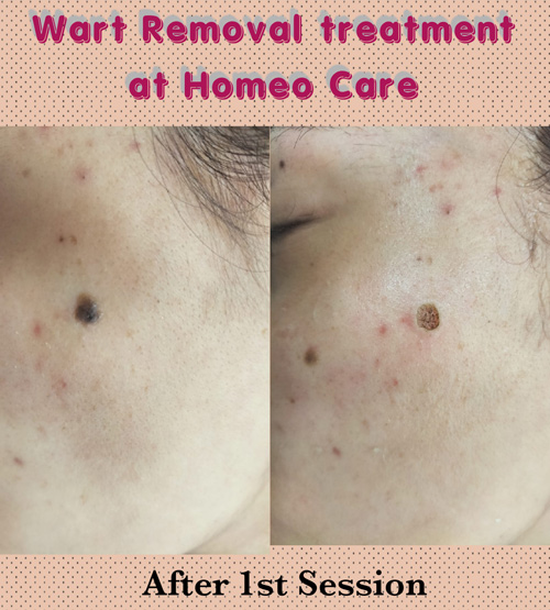 17-15-After-Before-5